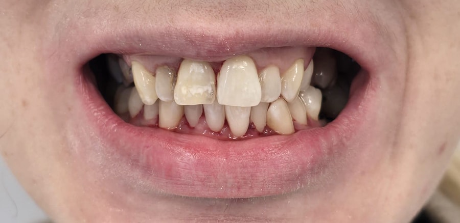 Cyfrowy Bonding Metamorfoza (2) Cyfrowy Bonding Metamorfoza (2)